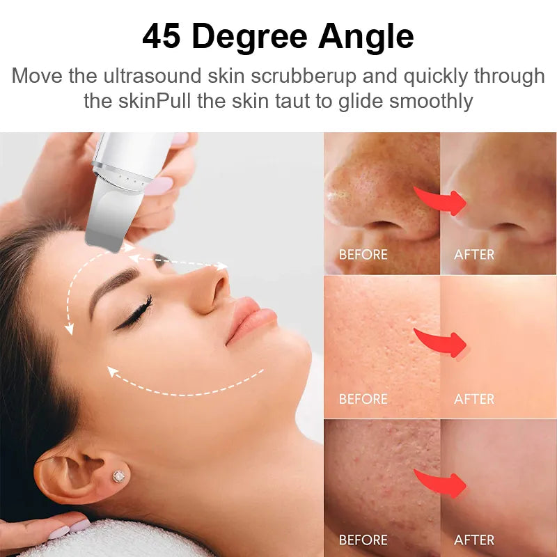 Vibrating Blackhead Remover