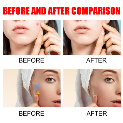Pimple Patches, Pimple Patches For Face, Hydrocolloid Acne Patches, Cute Star Stickers Hydrocolloid Acne Pimple Patch For Covering Zits And Blemishes
